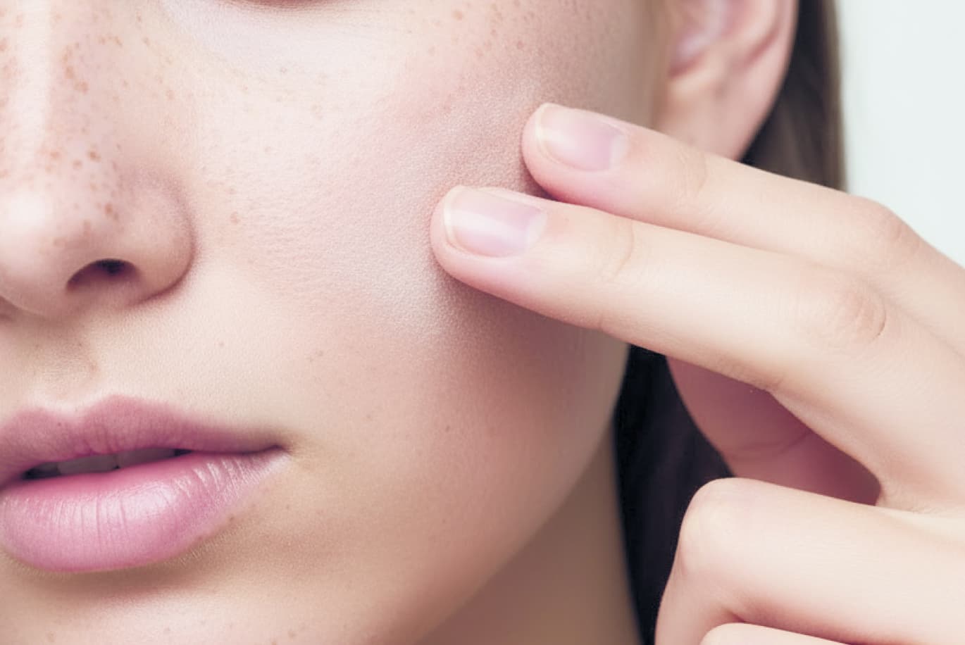 Freckles and Redness